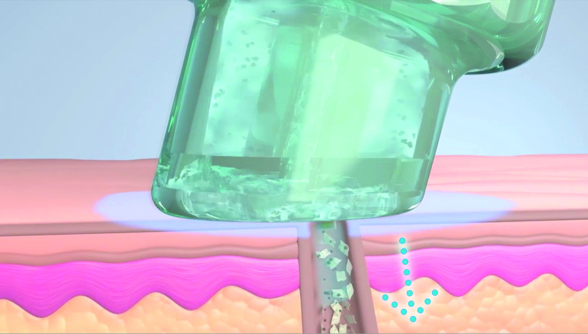 HydraFacial Schritt 2