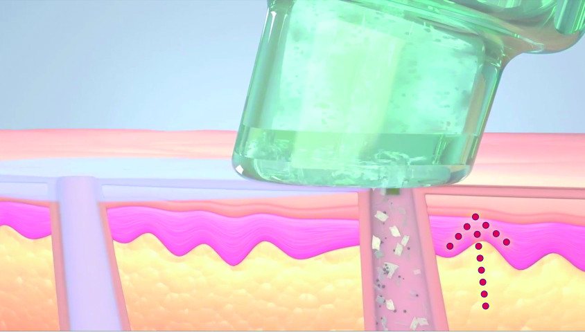 HydraFacial Schritt 3