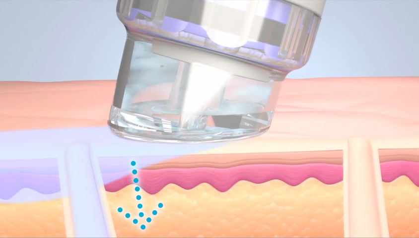 HydraFacial Schritt 4